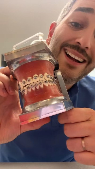 Le brossage avec des bagues