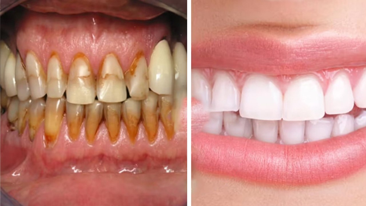 Gutkha Ke Dant Kaise Saaf Kare Jaate Hain, दांतो के काले धब्बे हटाने का घरेलू उपाय | Boldsky