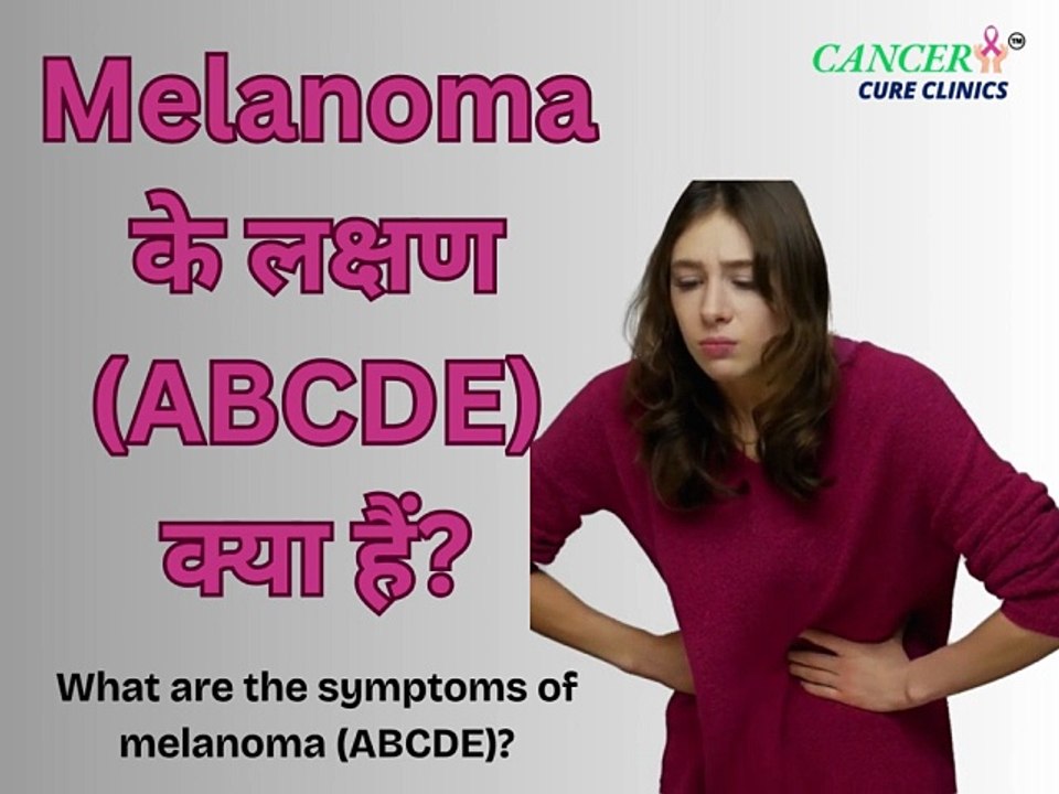 What Are the Symptoms of Melanoma? (ABCDE Guide)