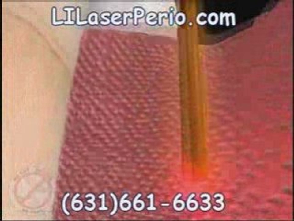 Periolase Gum Laser Long Island | LANAP Long Island Suffolk