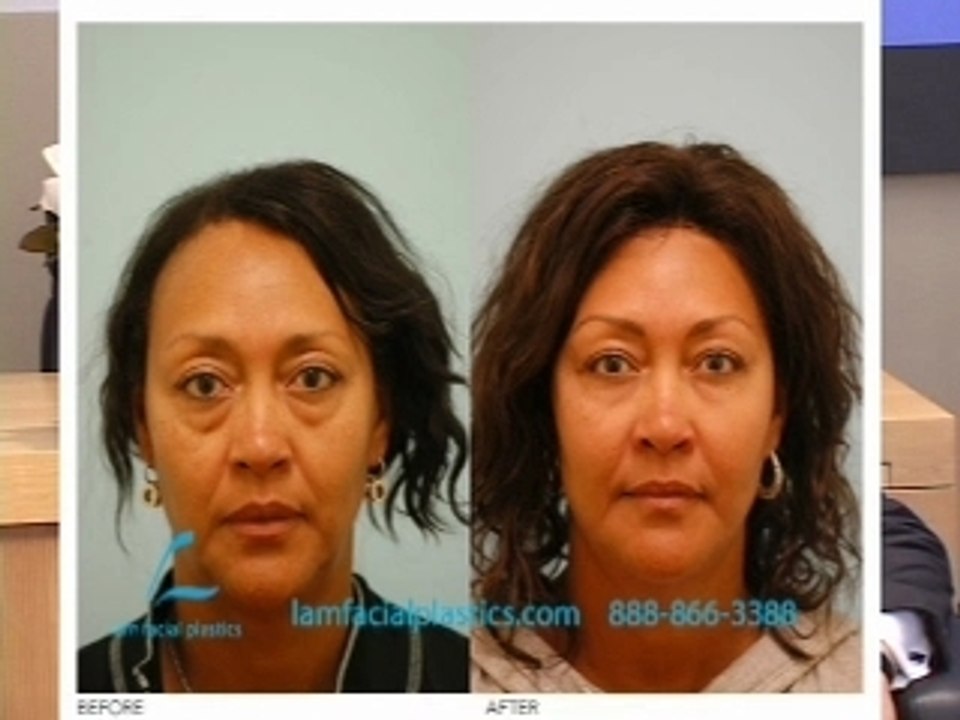 COSMETIC SURGERY DALLAS:  FILL VERSUS LIFT