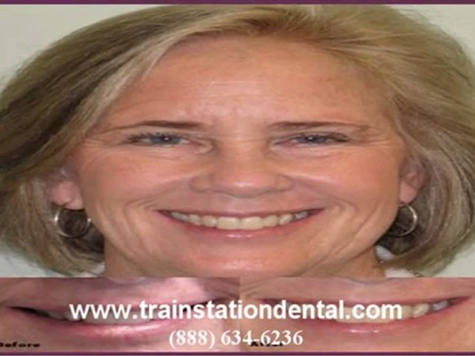 Cherry Hill Invisalign Invisalign in Cherry Hill