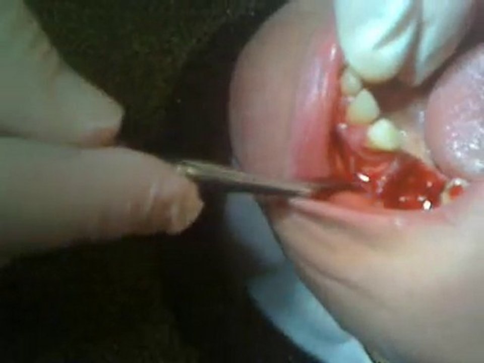 Extraction dentaire, Extraction racine(www.les-dents.com)