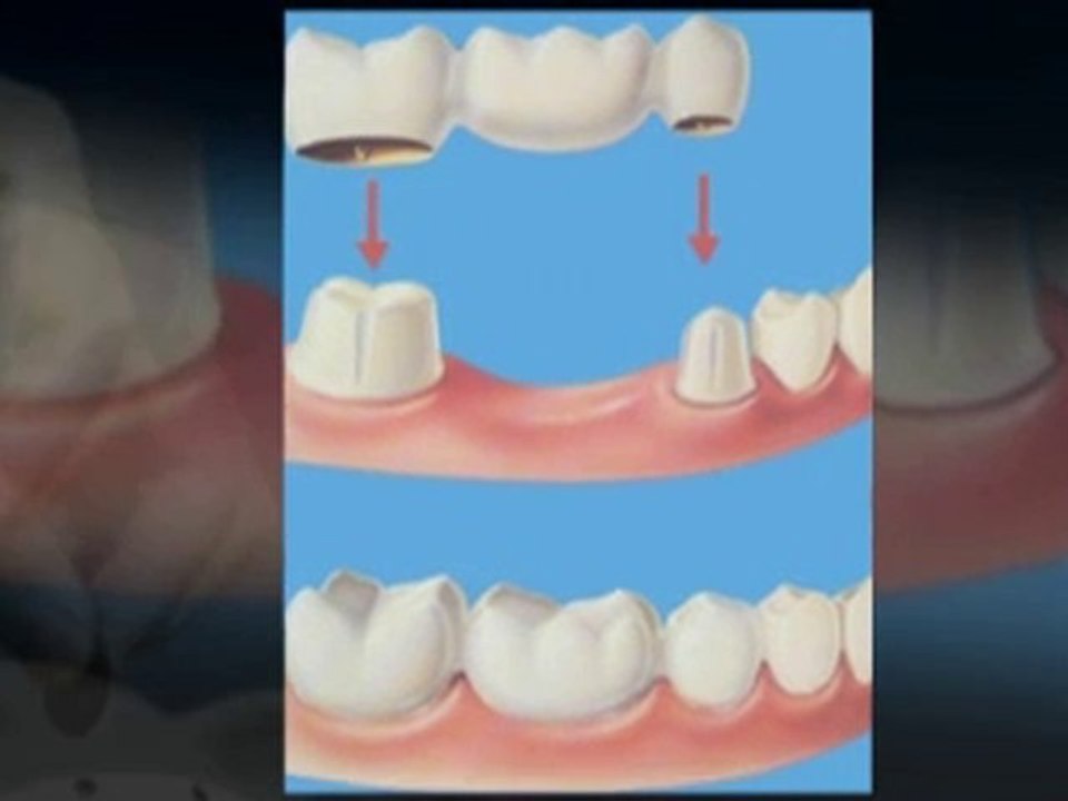 Crowns and Bridges explained by Oxford Dentist