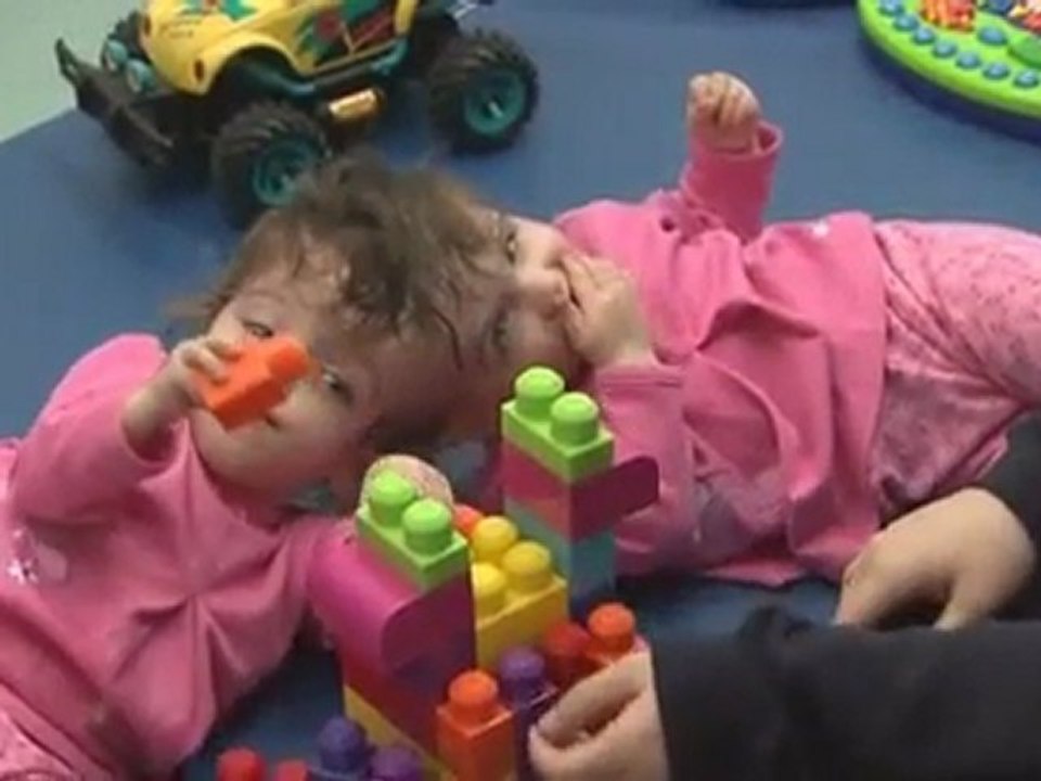 TWINS WHO SHARE A BRAIN