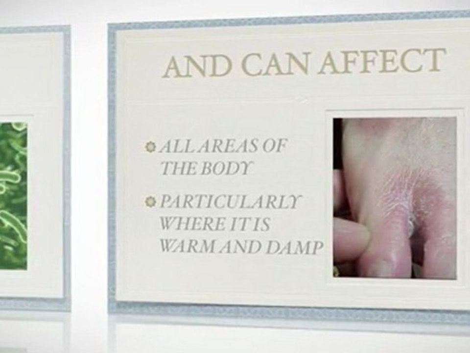 Thrush Symptoms: What are they and how to get rid of them