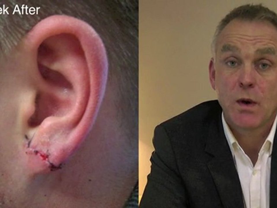 What are Tribal Earlobes and how are they repaired