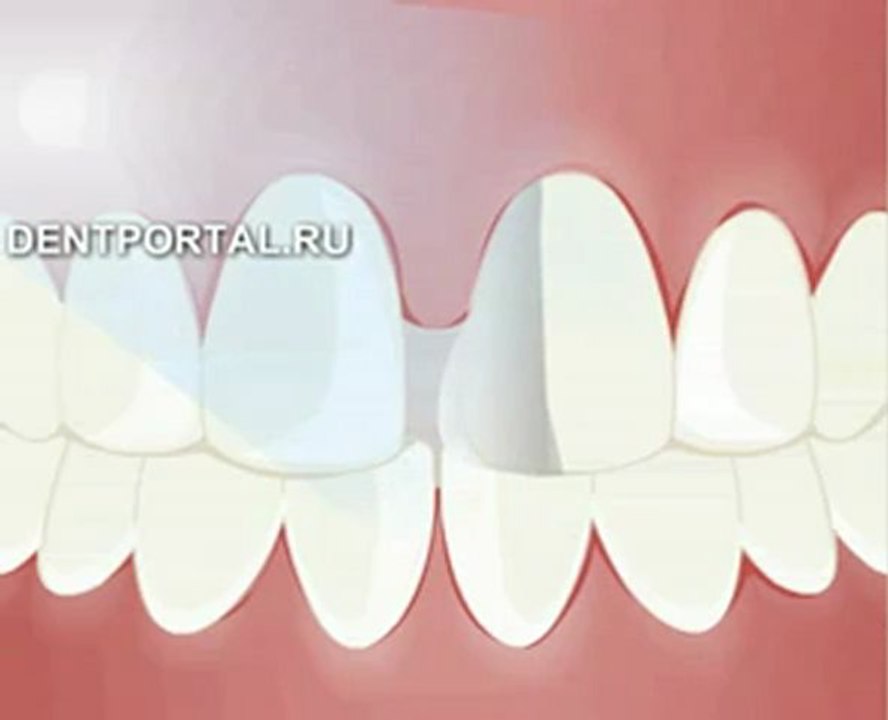 Закрытие диастемы