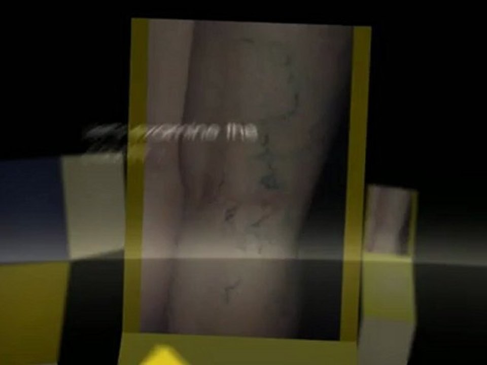 What Are Varicose Veins and How They Are Treated - Removing varicose veins