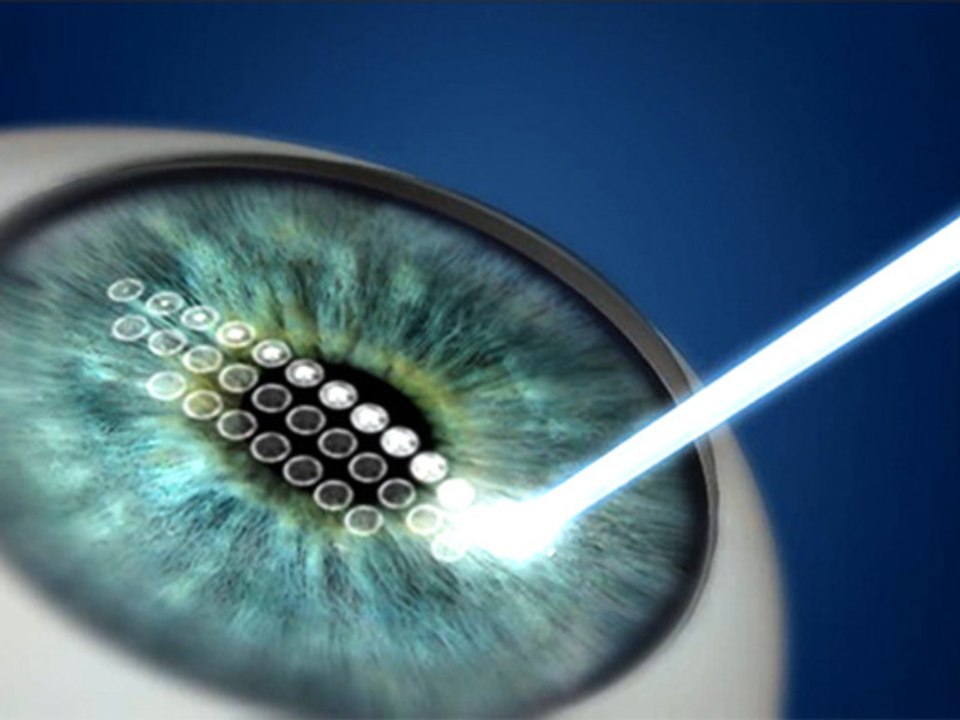 What Are The Different LASIK Types?