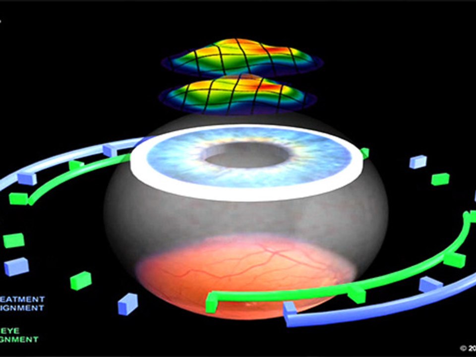 How does LASIK work ?