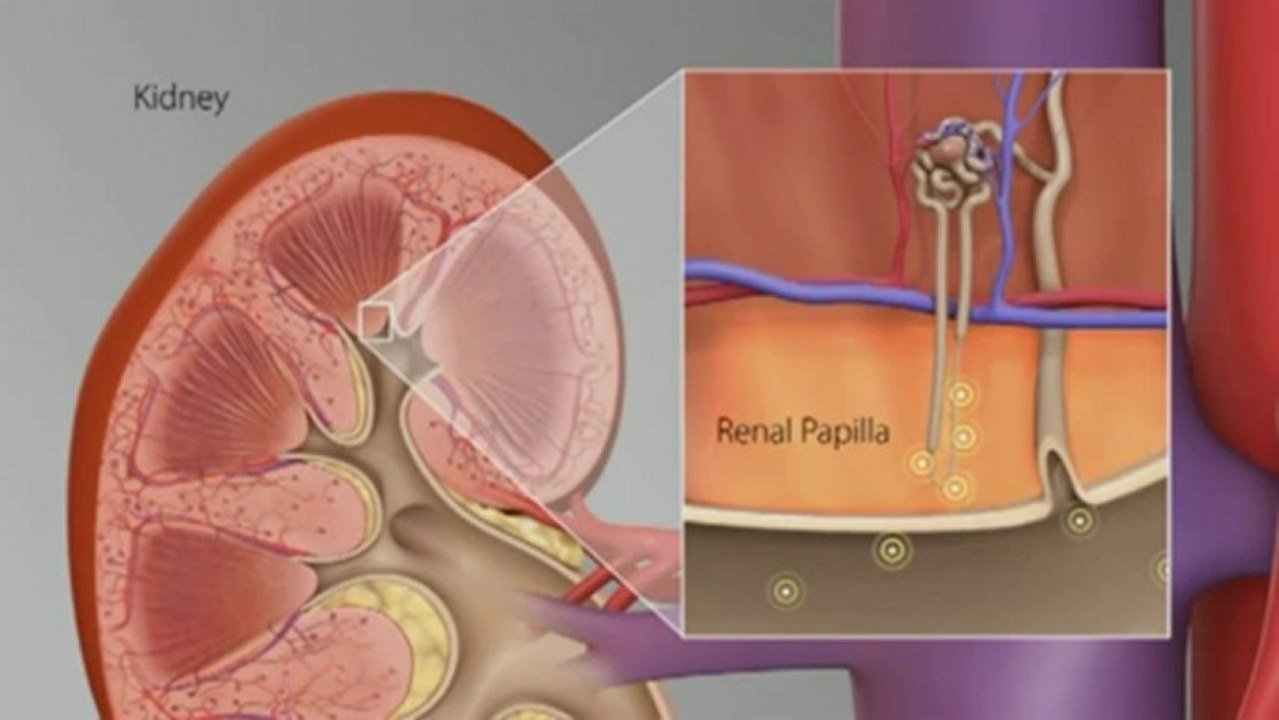 How Kidney Stones are Formed in the Kidneys