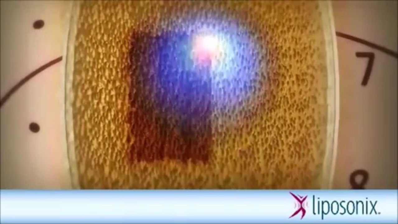 How Liposonix Ultrasound Works