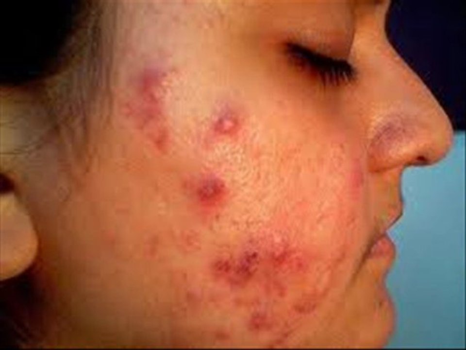 acne and pregnancy|acne and dairy|acne and birth control