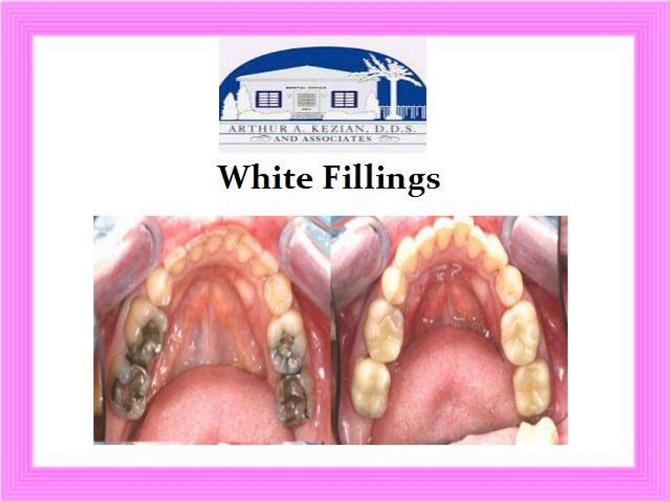 Different Types of Cosmetic Dentistry