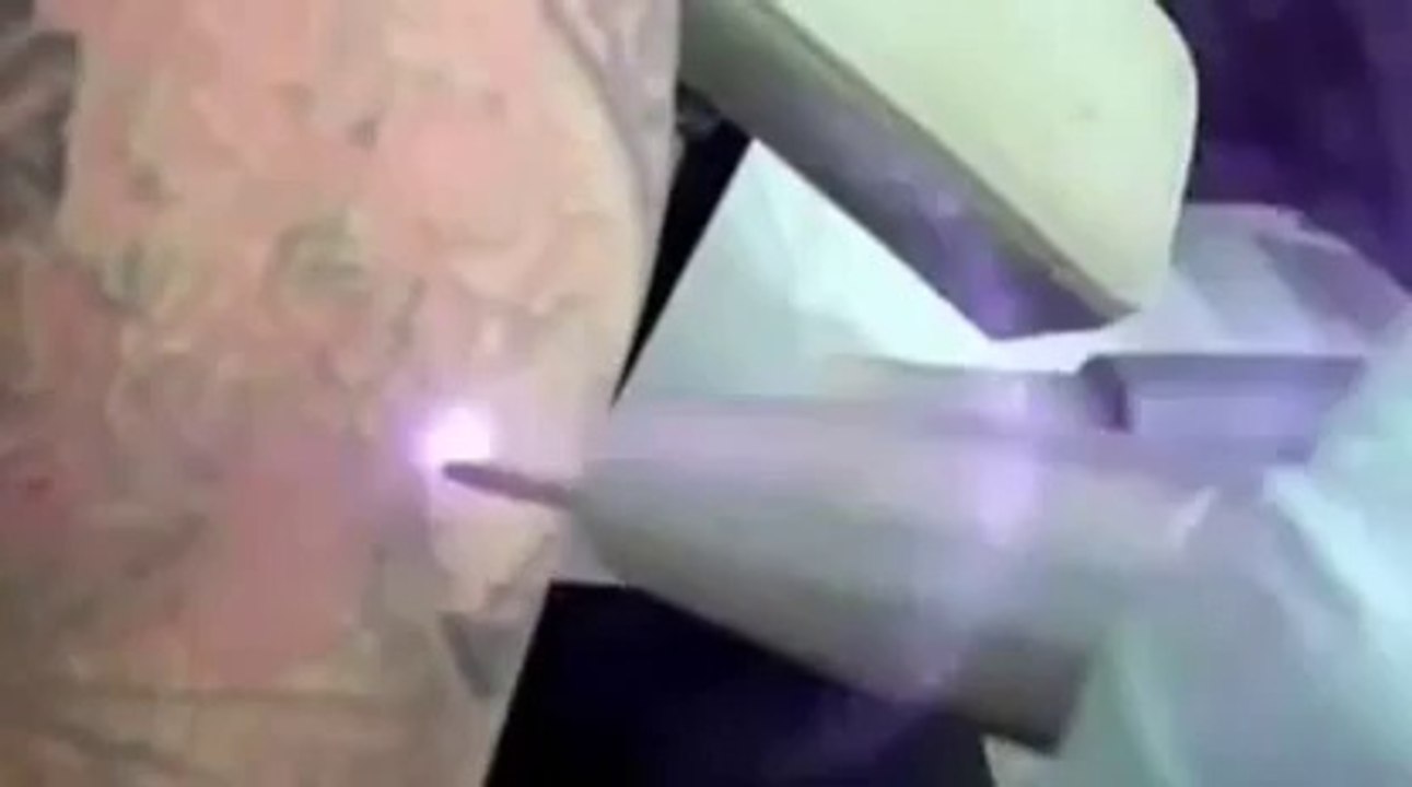 Tattoo Removal Methods And Procedures. Amazing Methods Revealed!