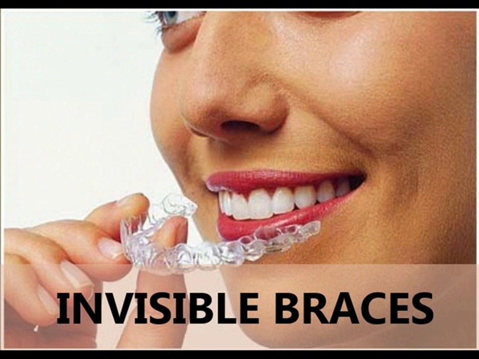 Various Types Of  Cosmetic Braces