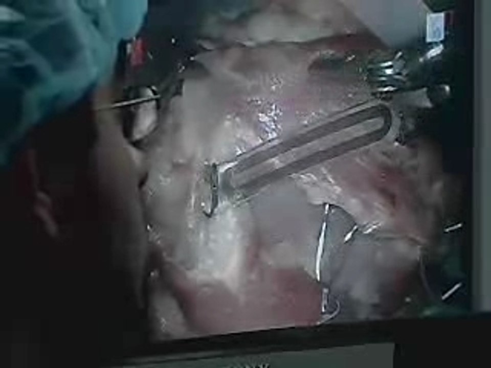 Voice of America Robotic Surgery - CMU