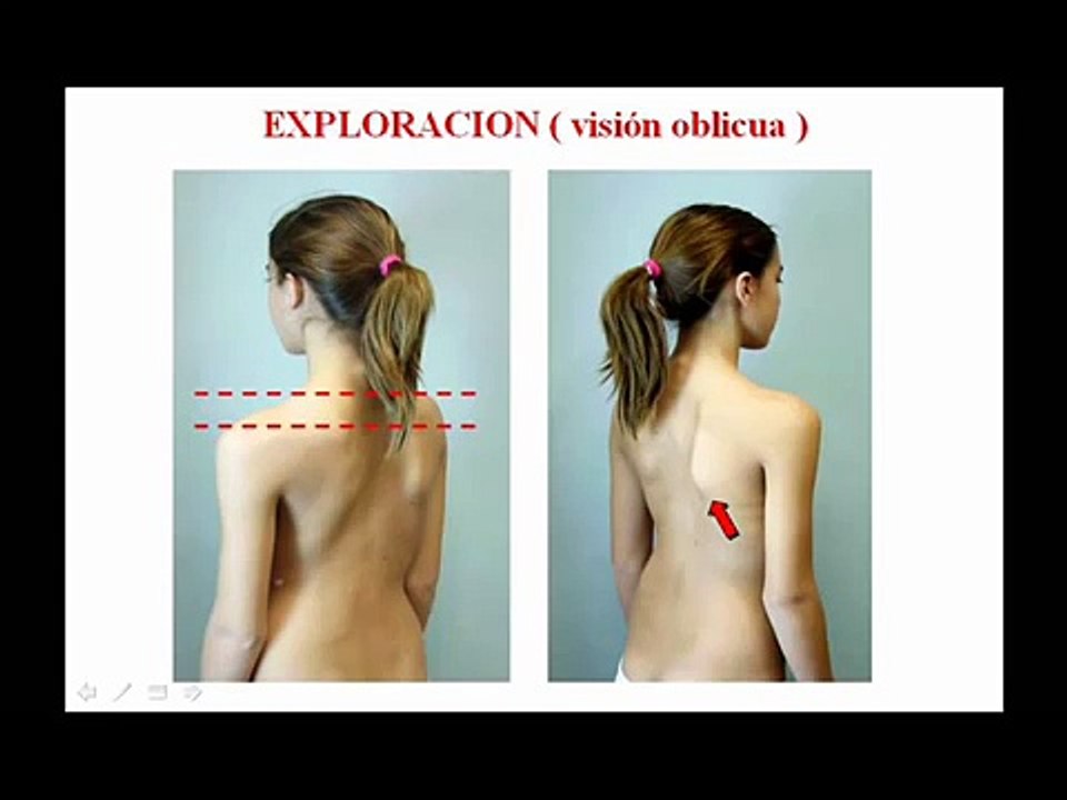 Escoliosis  Informacion Básica