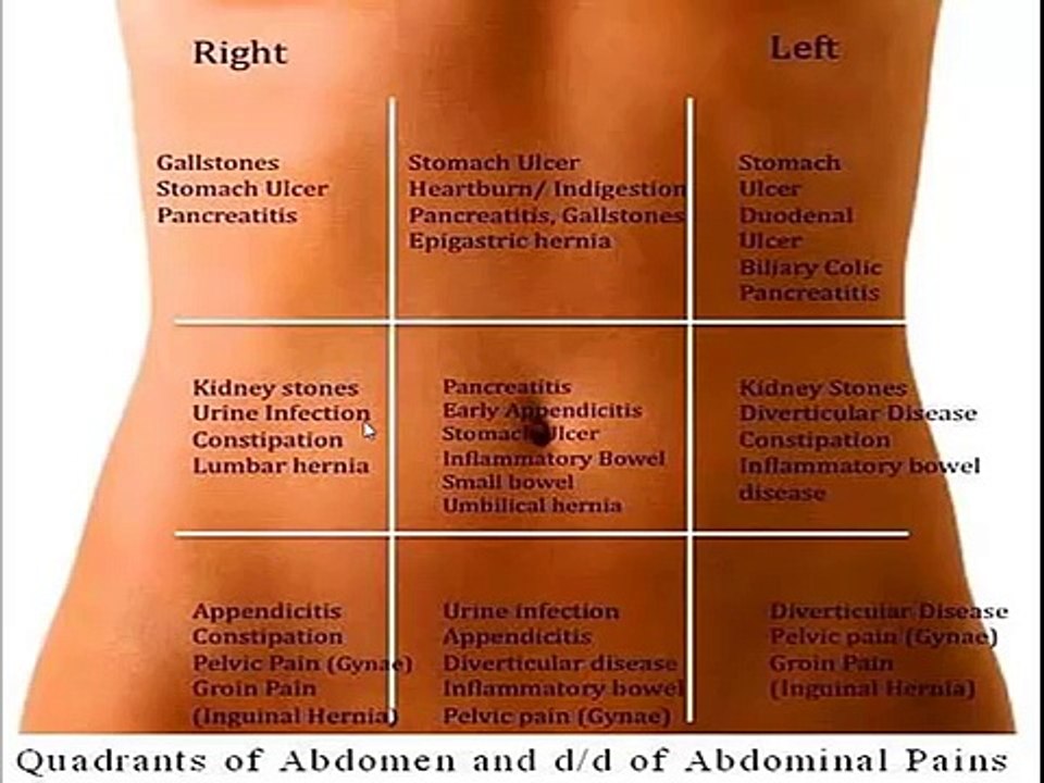 Differential diagnosis of abdominal pain according to abdominal regions
