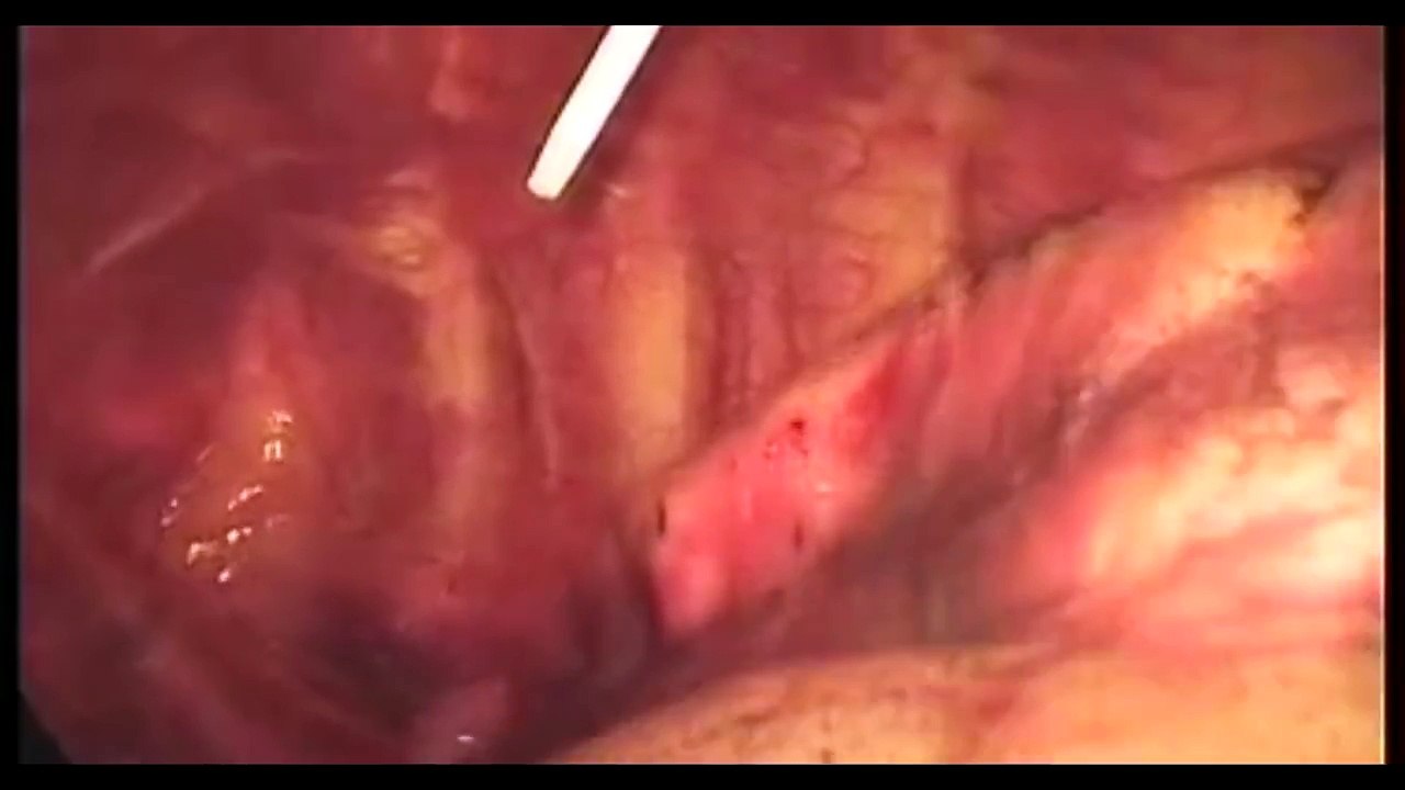Tension Pneumothorax and Needle Thoracostomy