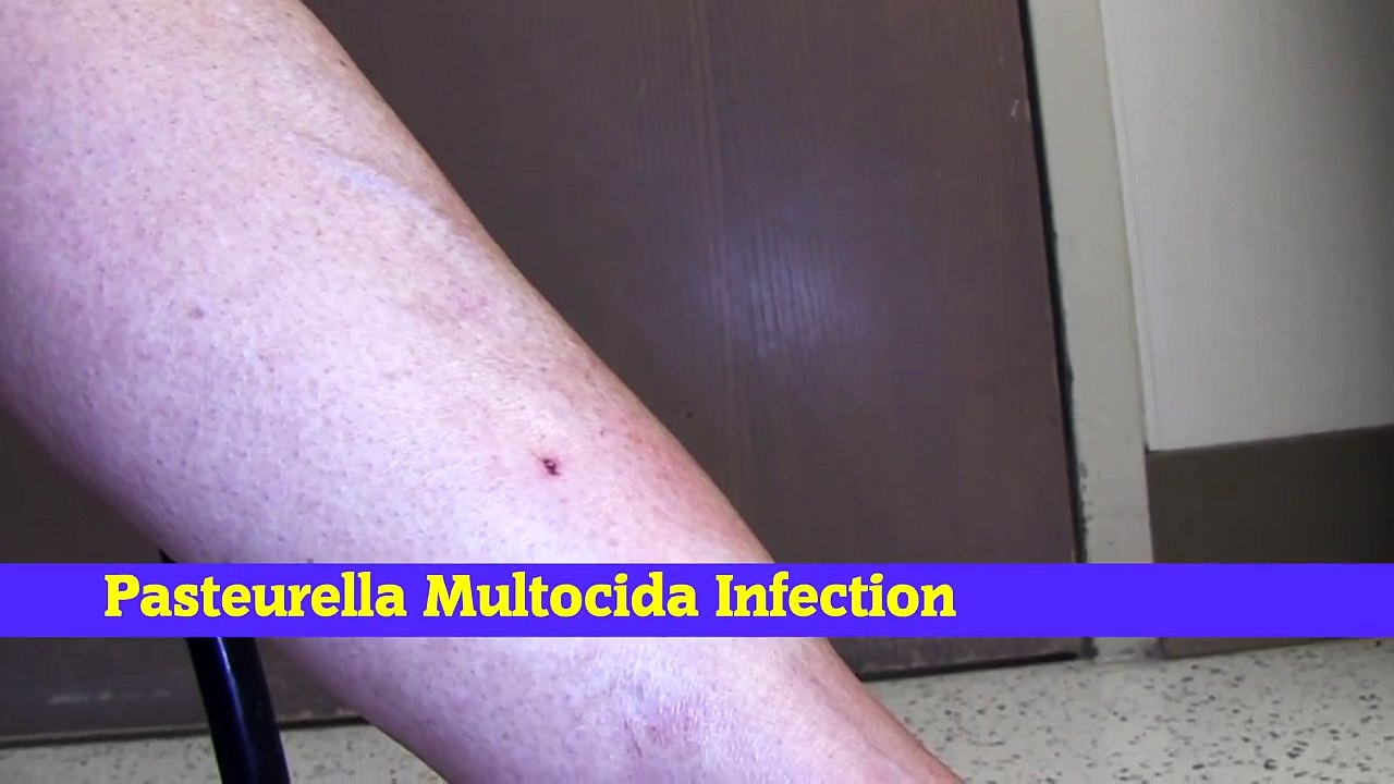 P. Multocida Cat Scratch Infection