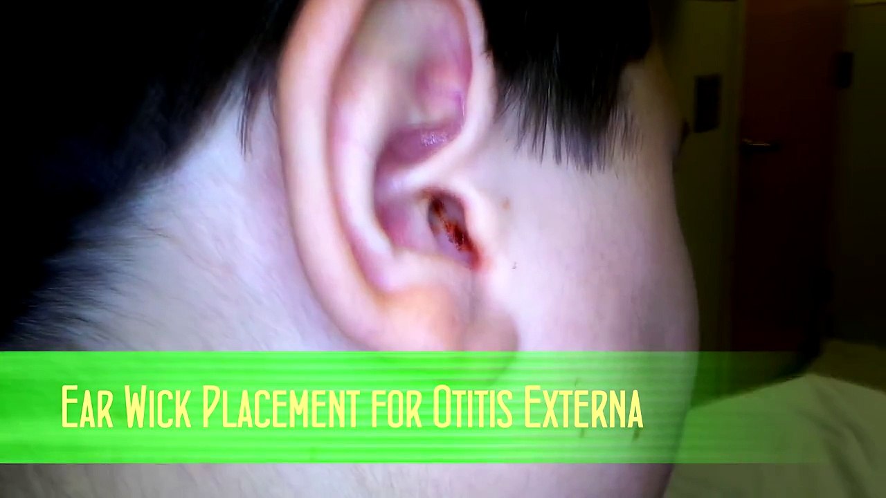 Ear Wick Placement for Otitis Externa