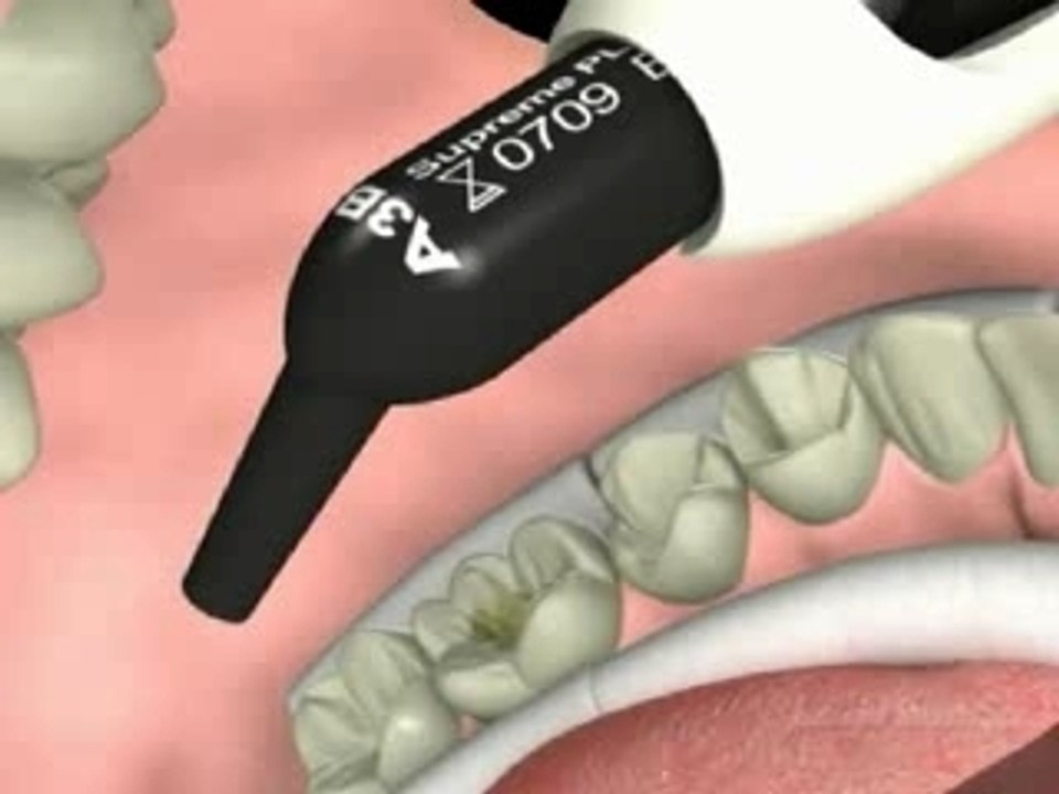 Composite postérieur