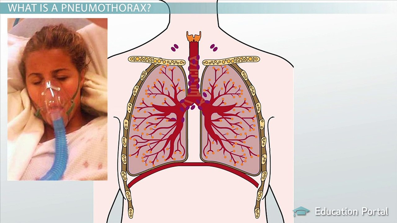 Pneumothorax and Atelectasis: Similarities, Differences & Causes