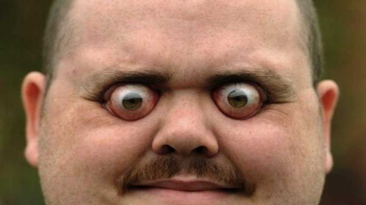 Differences Between Hashimoto's Thyroiditis and Grave's Disease