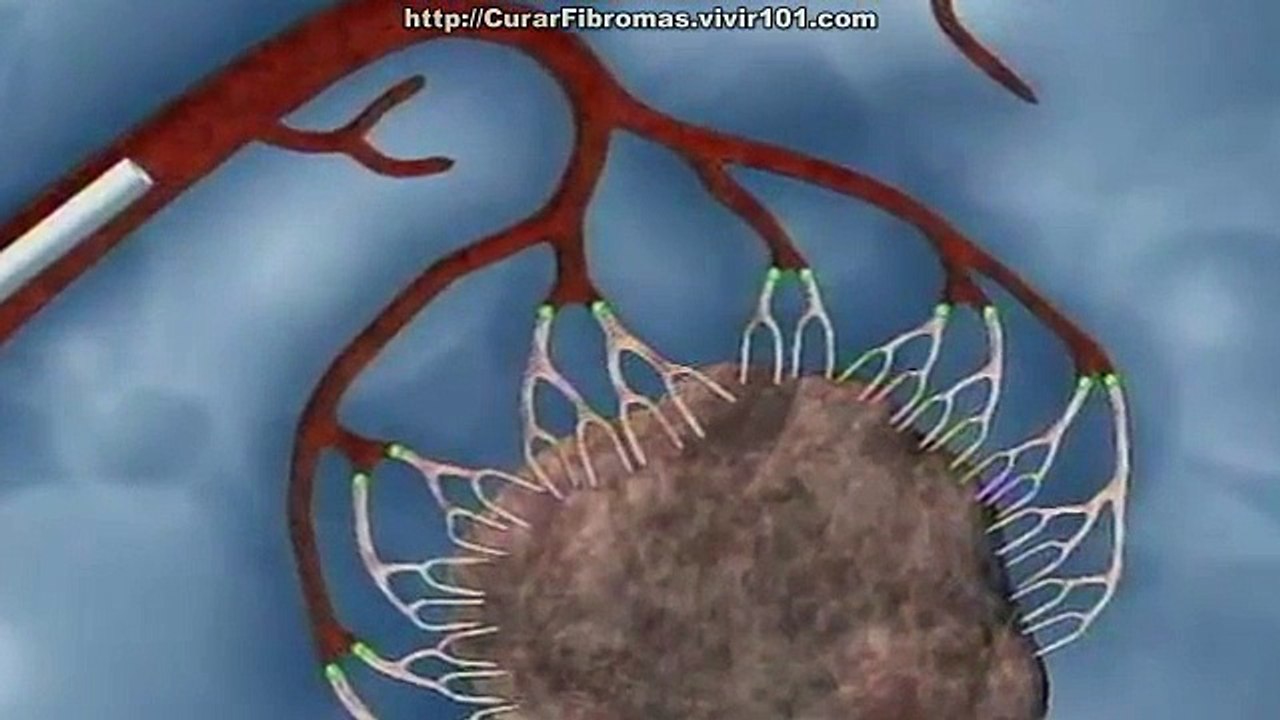 Eliza Mioma: Causes and Treatment Options