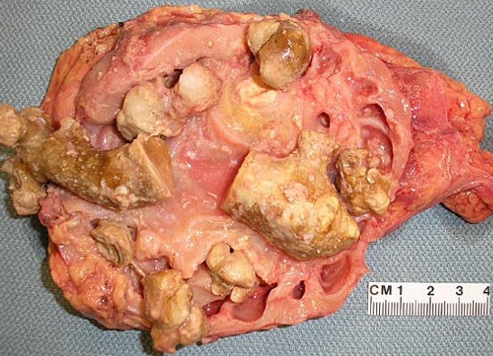What Are The Types Of Kidney Stones?
