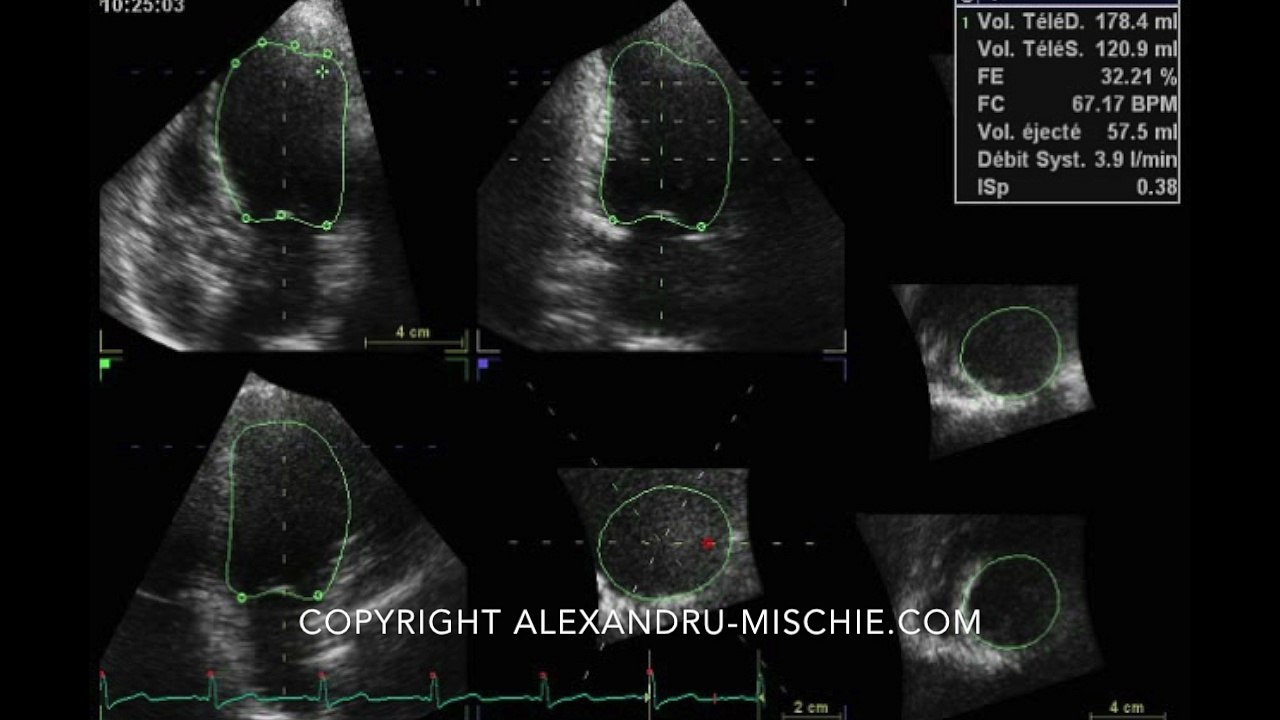 3D LVEF Examples: Left Ventricle Frames