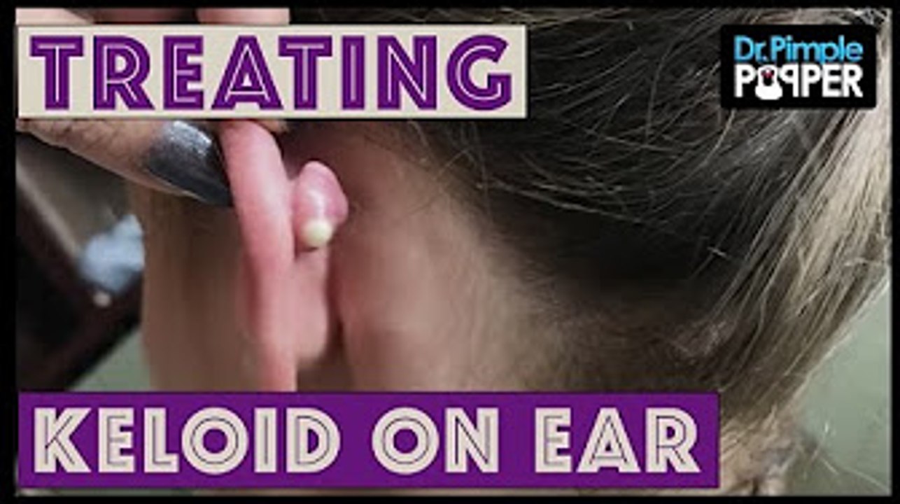 A Cute Keloid Treated with Cryoshape - YouTube & Dr Sandra Lee