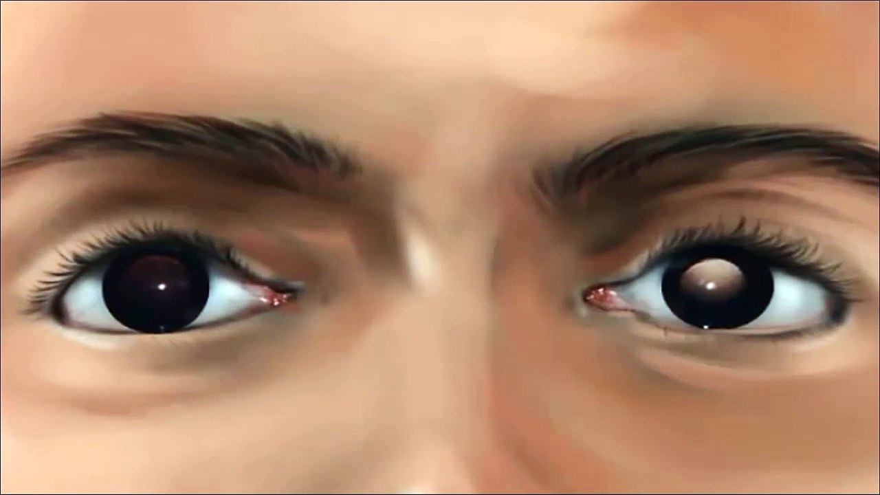 Understanding Anisometropia: Medical Definitions