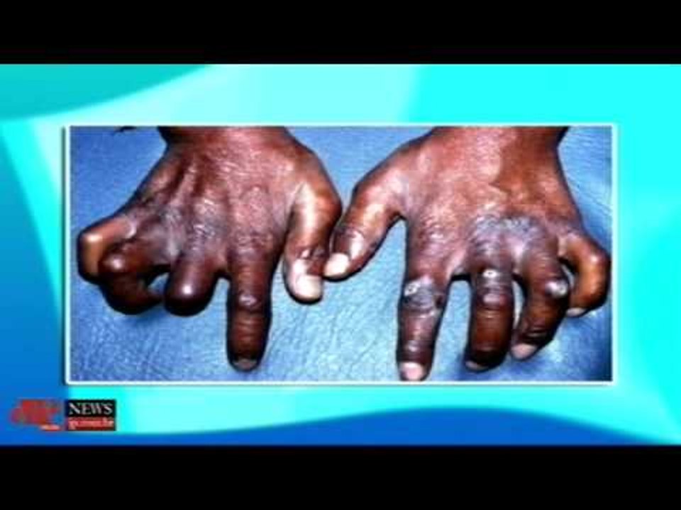 Preconceito é maior dificuldade de quem tem a Hanseníase