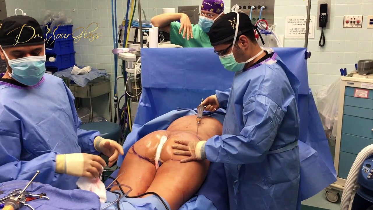 Correcting Buttock Asymmetric with Fat Transfer