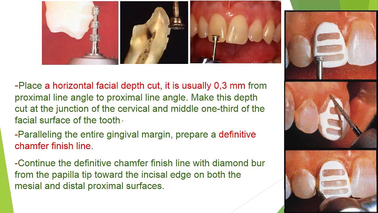 Veneers step by step