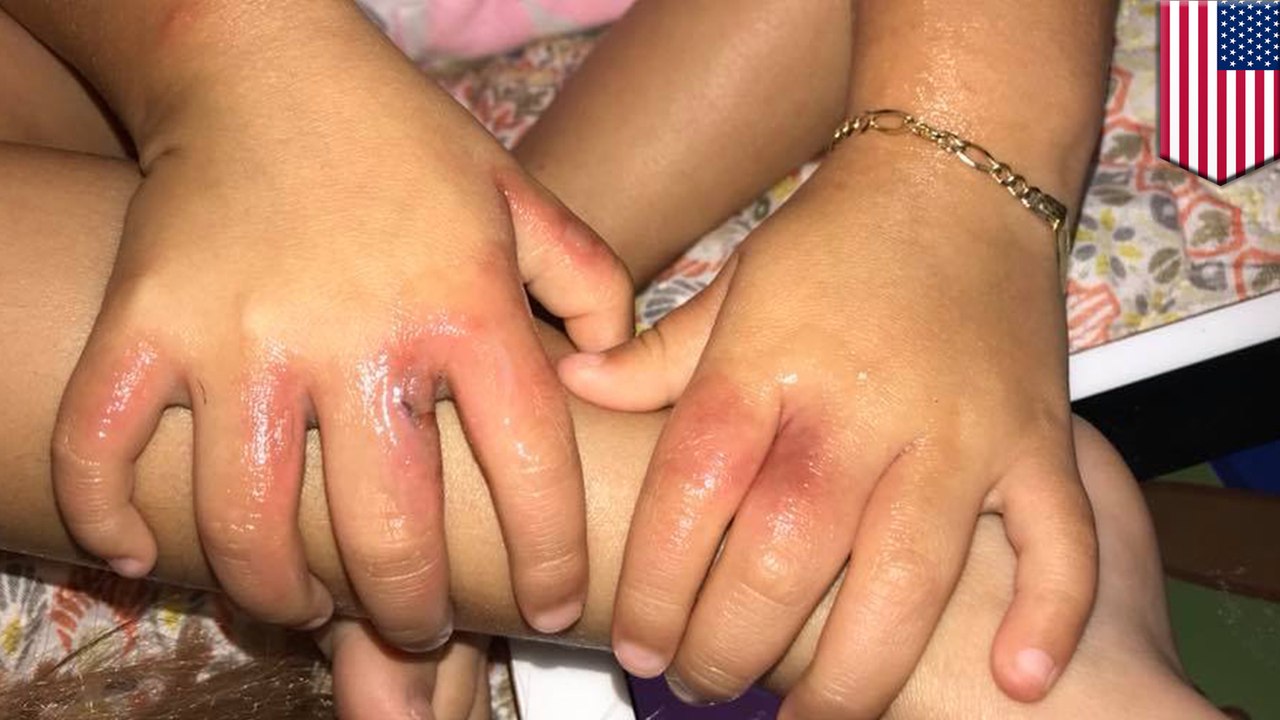 Little girl suffers from bacterial infection after beach day - TomoNews