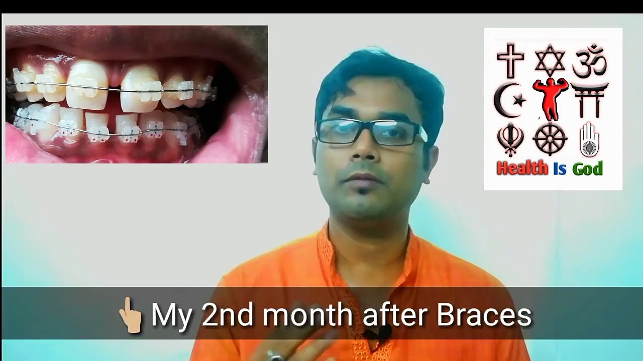 TYPES AND COST OF BRACES(HINDI)