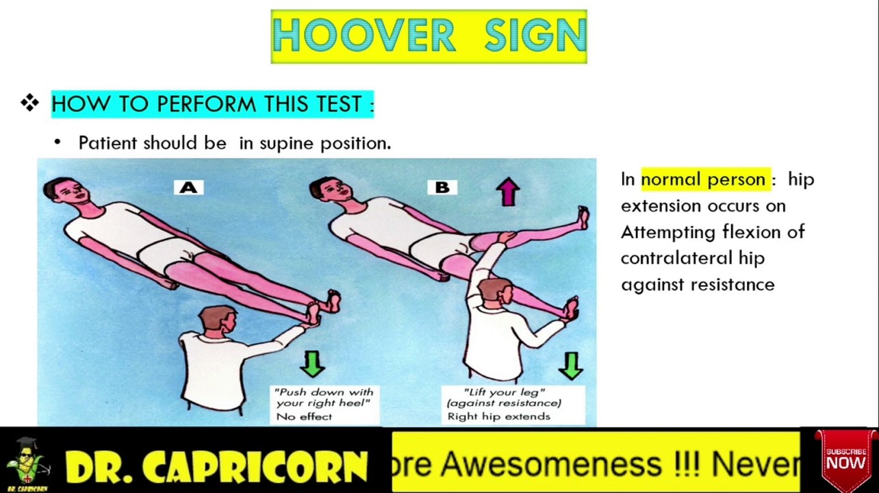 HOOVER'S SIGN /LEG PARESIS/CROSSED-EXTENSOR REFLEX/COPD/EMPHYSEMA/NEET/UNACADEMY/MBBS MADE EASY