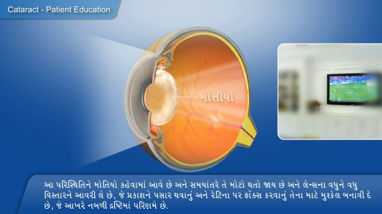 What is cataract? Basic information in Gujarati