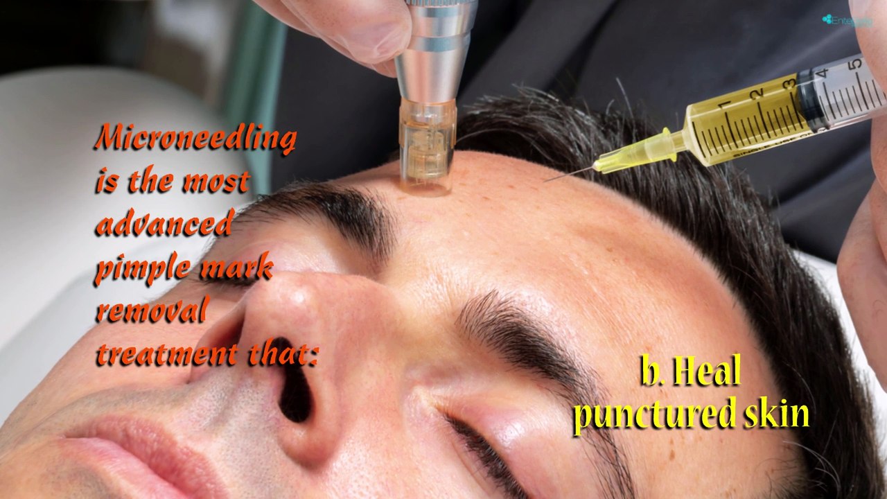 Top Acne Treatments to Clear Your Skin and Reduce Scars ✨