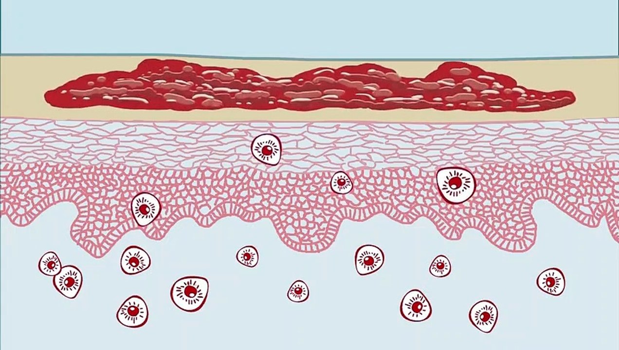 O que é a psoríase?
