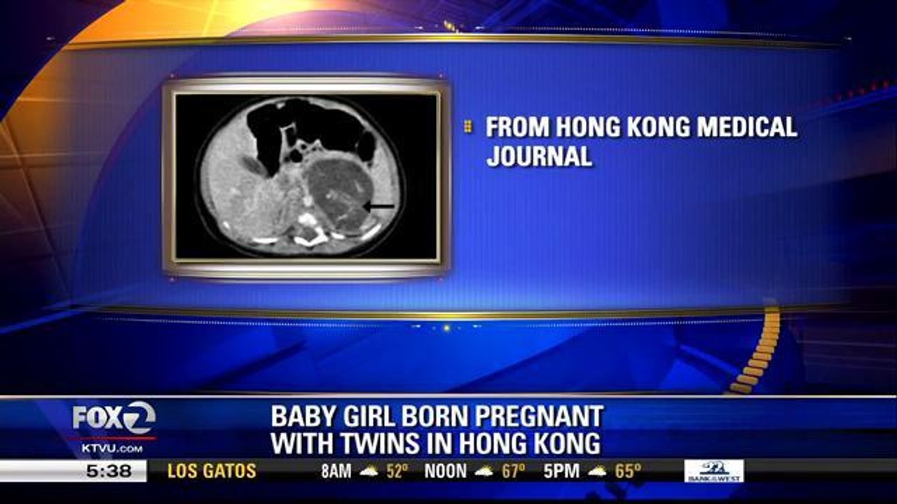 Baby Girl Born Pregnant With Twins In Hong Kong