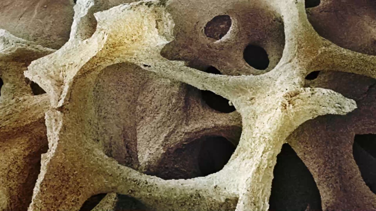 What is multiple Myeloma, a type of bone marrow cancer?