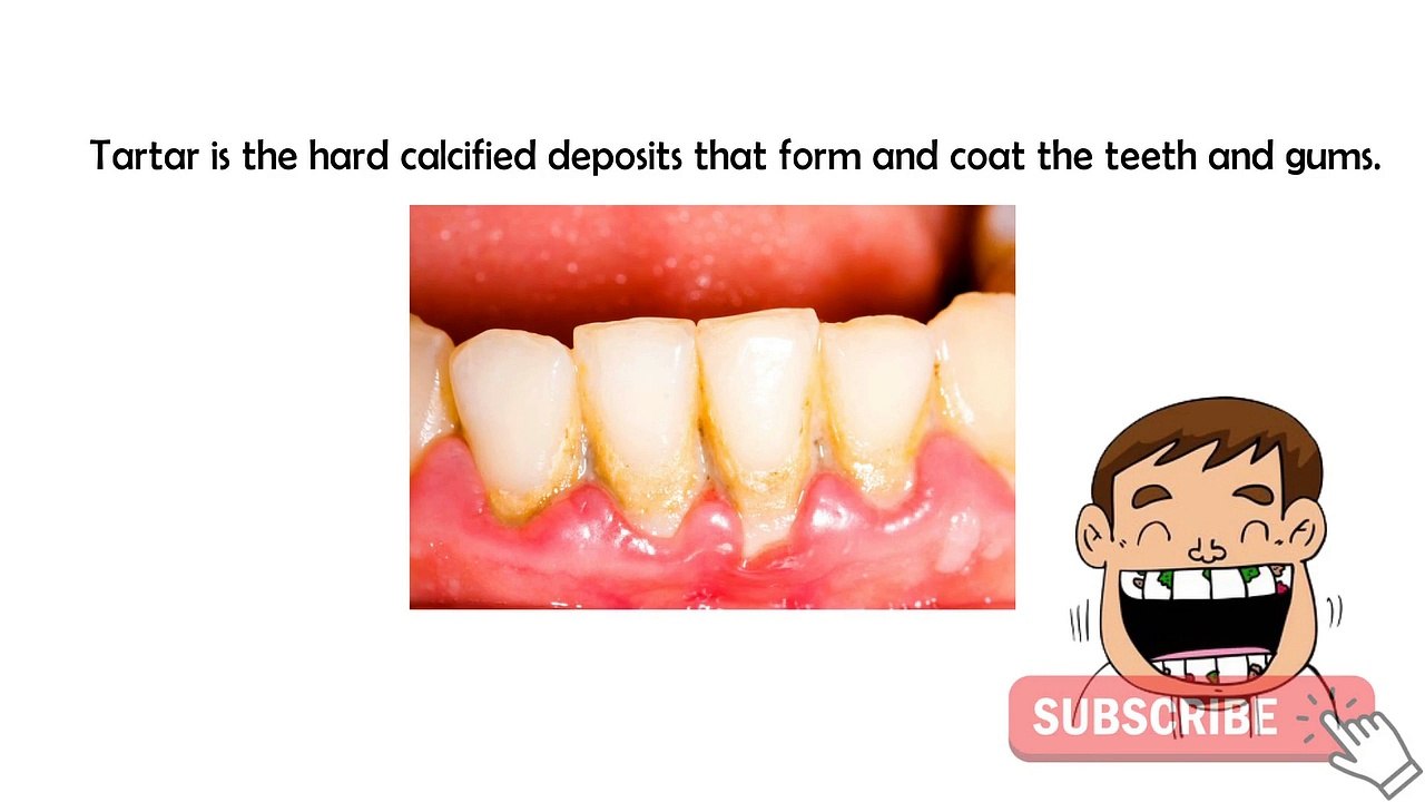 Tartar on teeth: How to safely remove tartar buildup on teeth at home