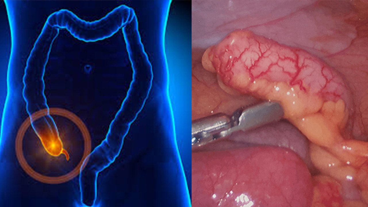 Appendix का दर्द क्या होता है? । Appendix ka dard kyu hota hai । Boldsky* Health