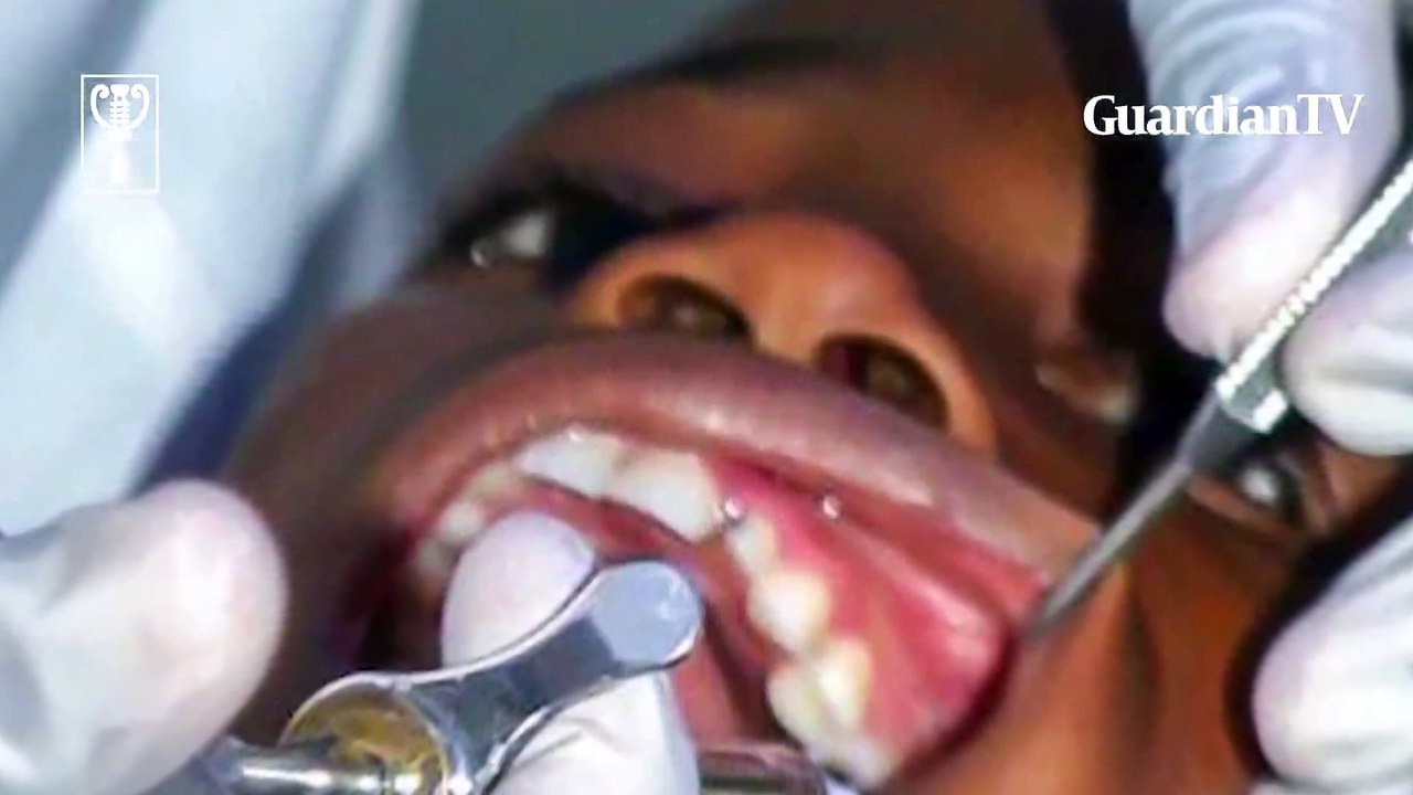 Explaining cleft lip and palate