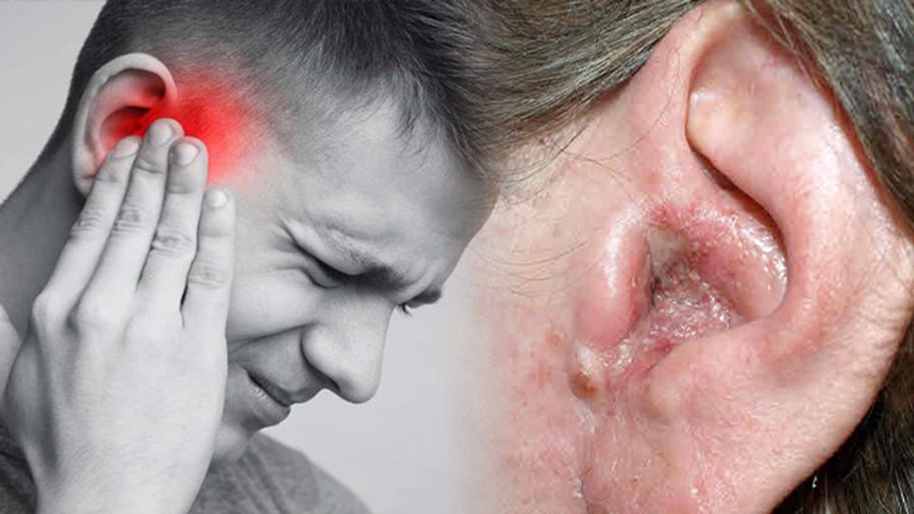 कान बहना बंद कैसे करें | कान बहना बंद करने का घरेलु उपाय | Boldsky *health